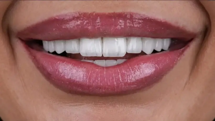 Before and after a full smile makeover with veneers at Esthetic Dent in Costa Rica — after