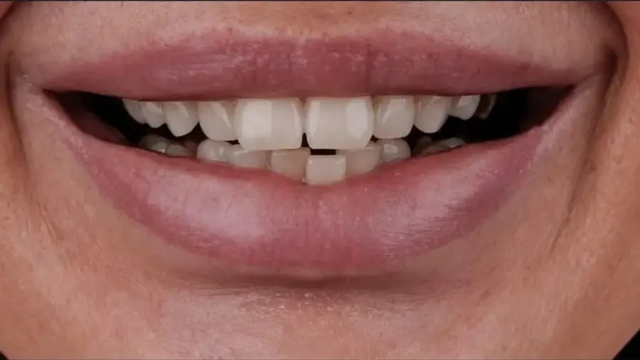 Before and after a full smile makeover with veneers at Esthetic Dent in Costa Rica — before