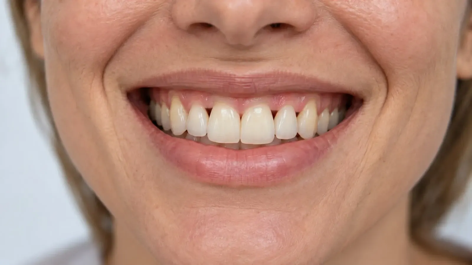 Primer plano de una sonrisa con las encías visibles, mostrando el estado de salud bucal a evaluar