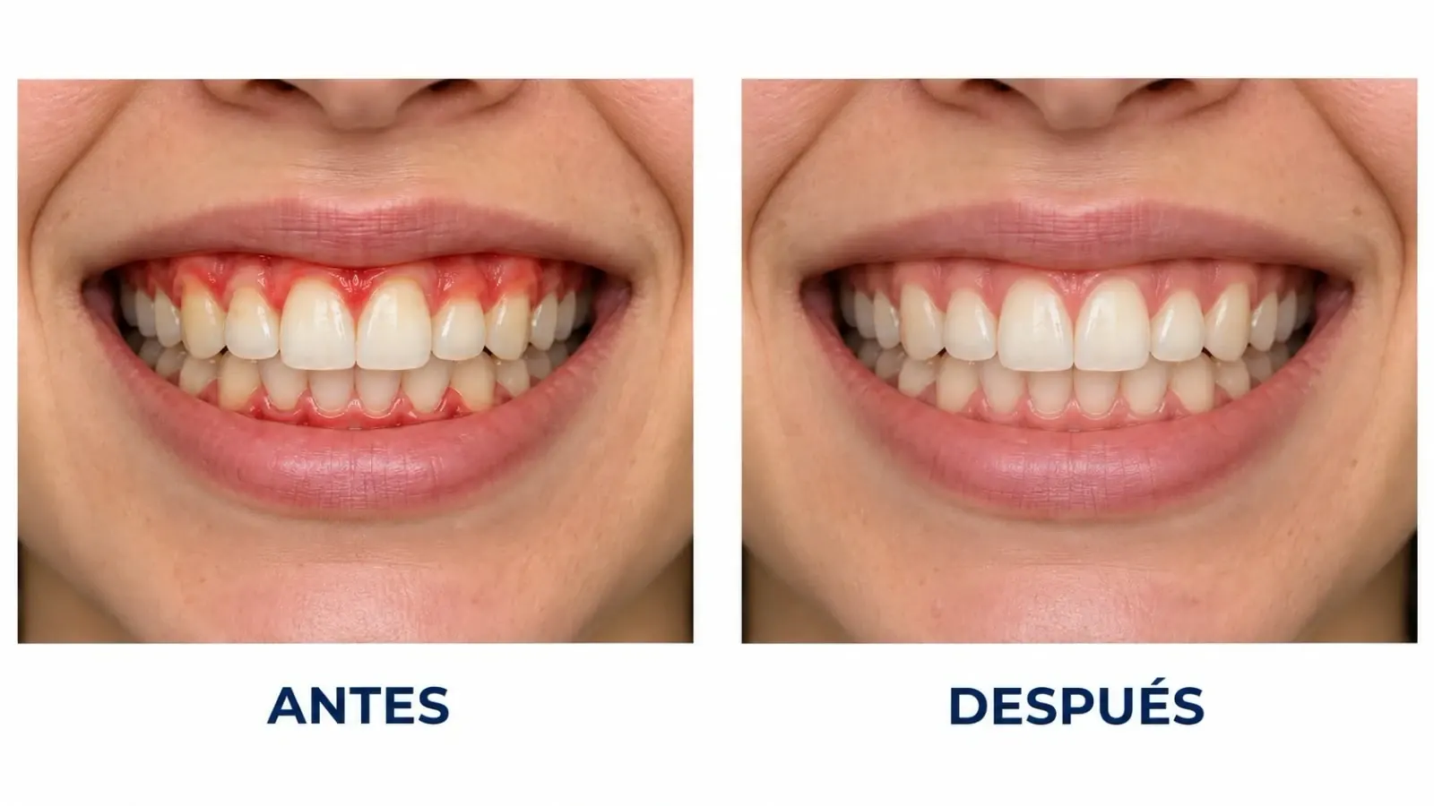 Comparación antes y después de un tratamiento periodontal, mostrando la reducción de la inflamación en las encías