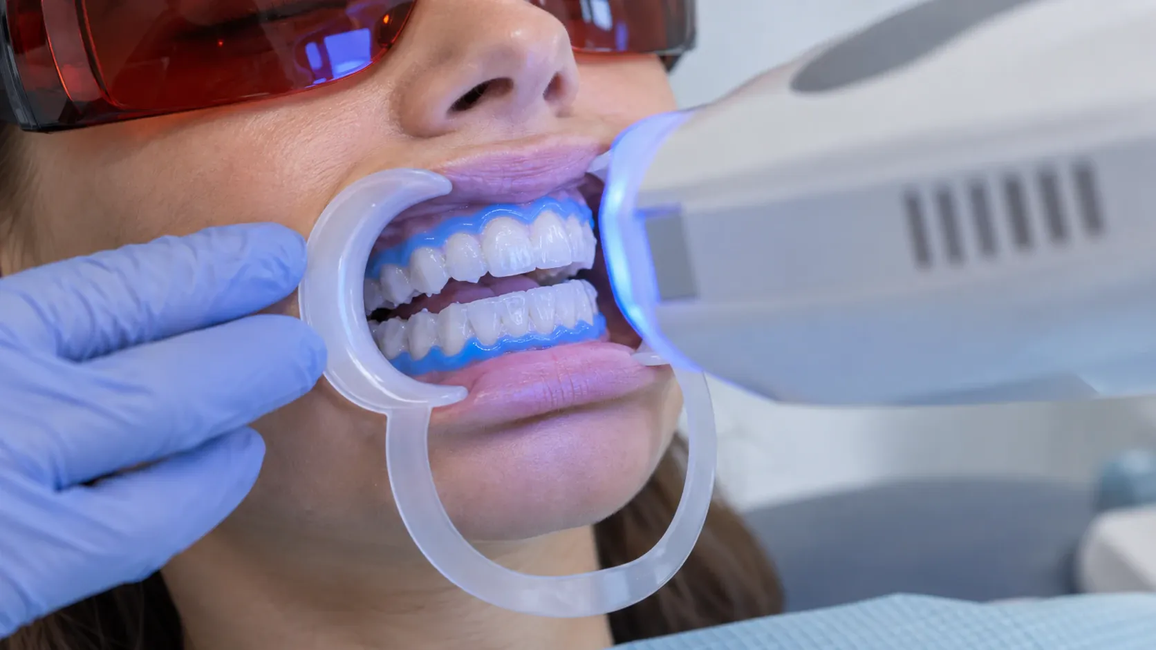 Primer plano de dientes durante una sesión de blanqueamiento con lámpara LED