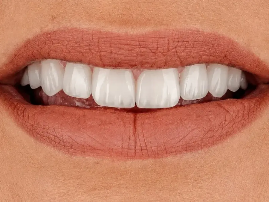 Después de carillas dentales en Esthetic Dent