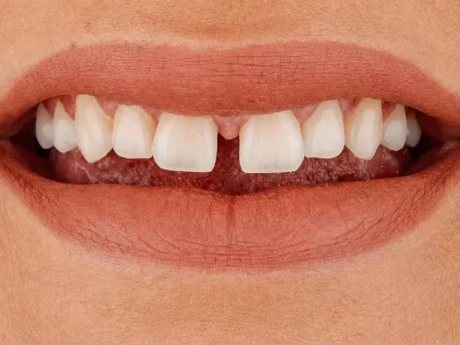 Antes de carillas dentales en Esthetic Dent